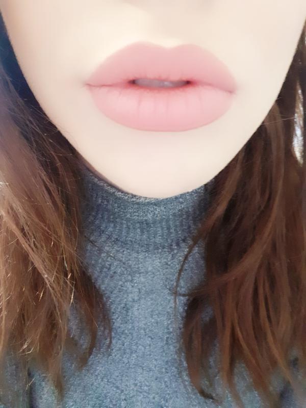 Meticulous and pain free lip augmentation