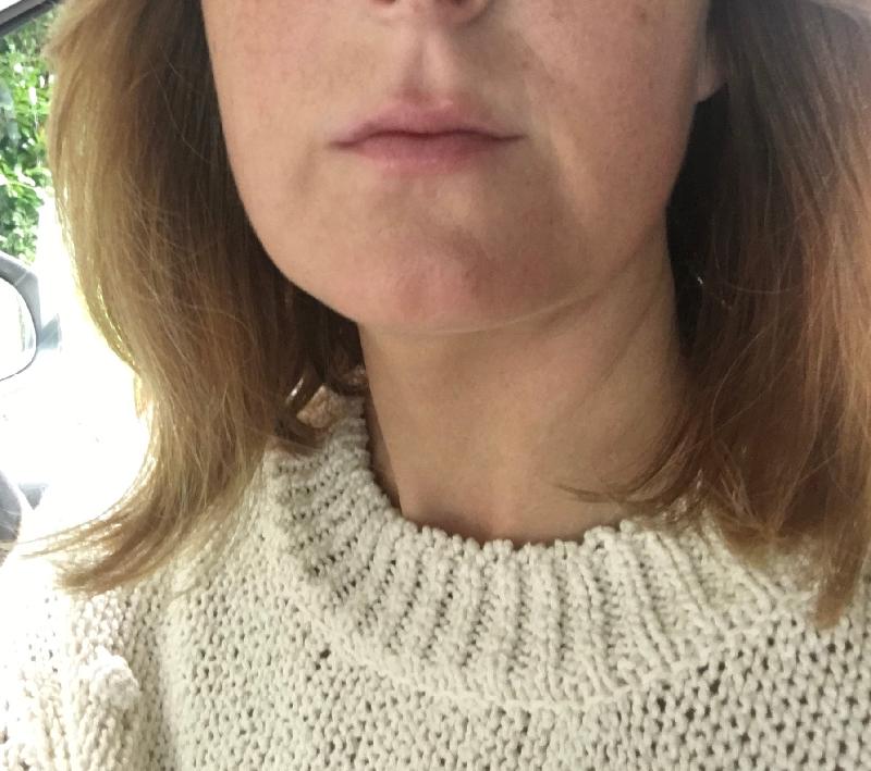 Dr Gareth fab experience ! natural result **