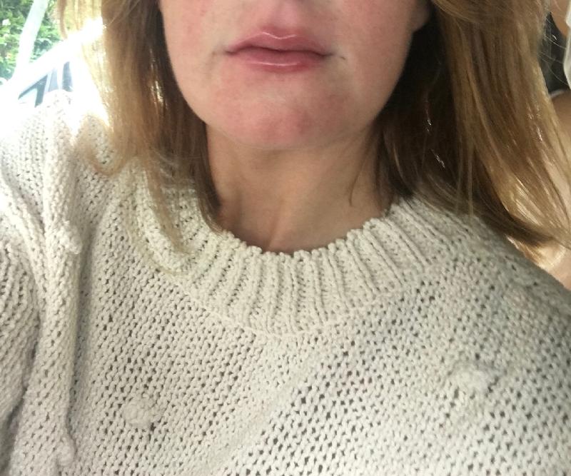 Dr Gareth fab experience ! natural result **