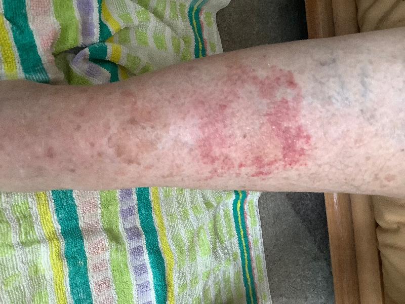 It quickly cleared a nasty rash.