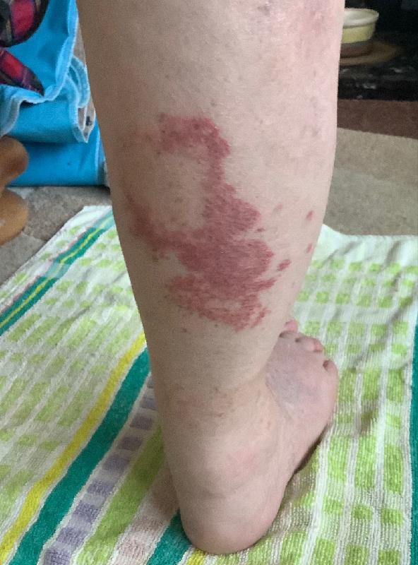 It quickly cleared a nasty rash.