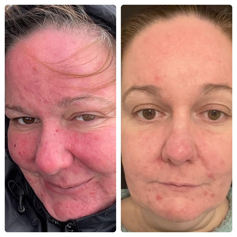 Outstanding results for my rosacea  I could not be happie