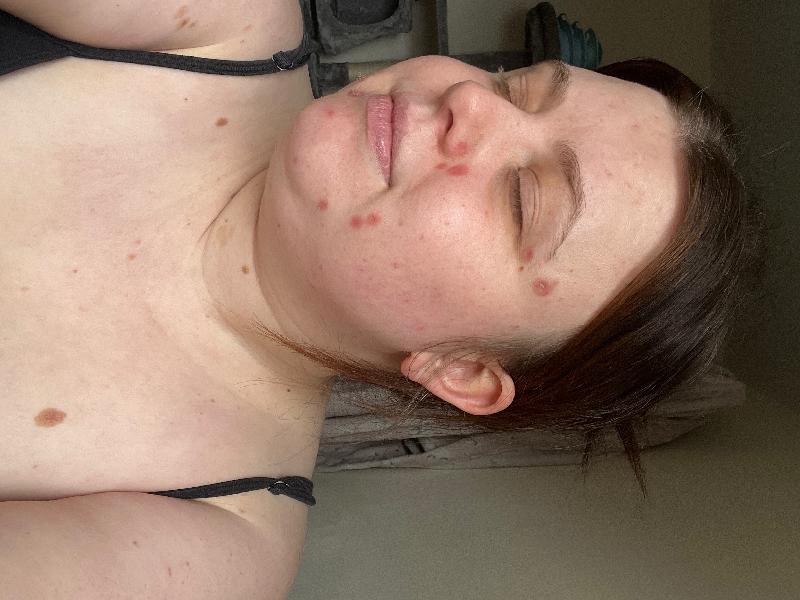I had 15 moles removed, the surgeon was kind patient and brilliant with me