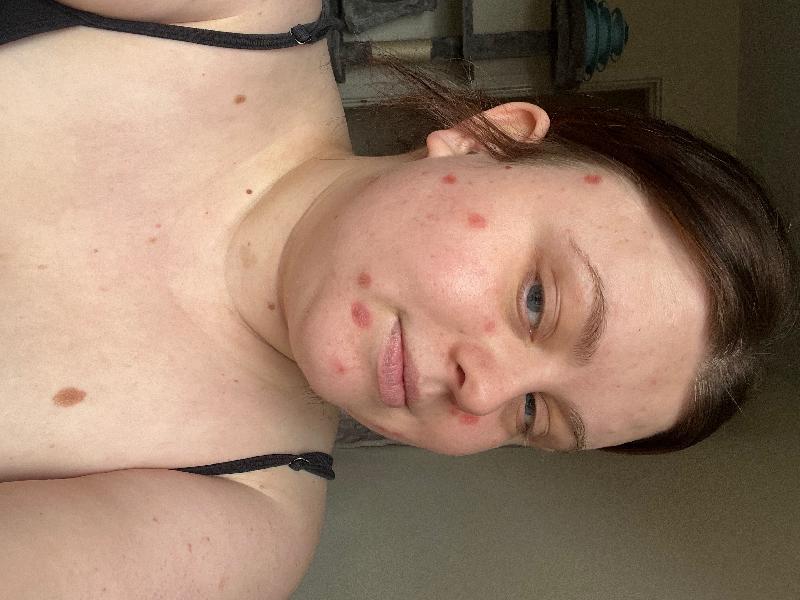 I had 15 moles removed, the surgeon was kind patient and brilliant with me