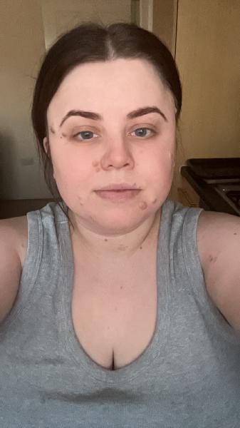 I had 15 moles removed, the surgeon was kind patient and brilliant with me