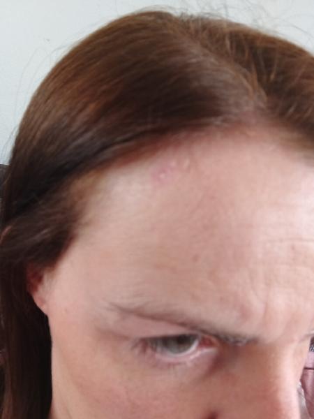 Excellent skin clinic. I had mole removal with fantastic results