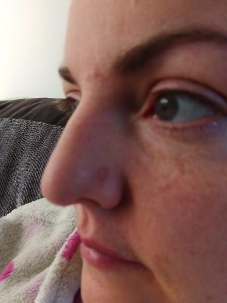 Excellent skin clinic. I had mole removal with fantastic results