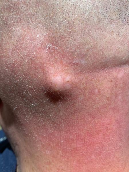 Excellent Cyst removal procedure