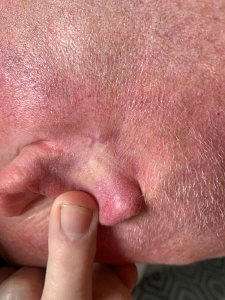 Excellent Cyst removal procedure