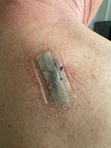 My cyst removal