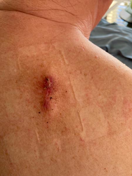 My cyst removal