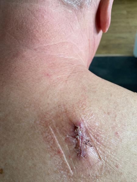 My cyst removal