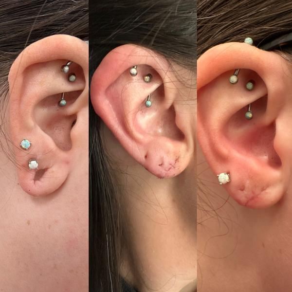 Stretched Ear Lobe Reconstruction