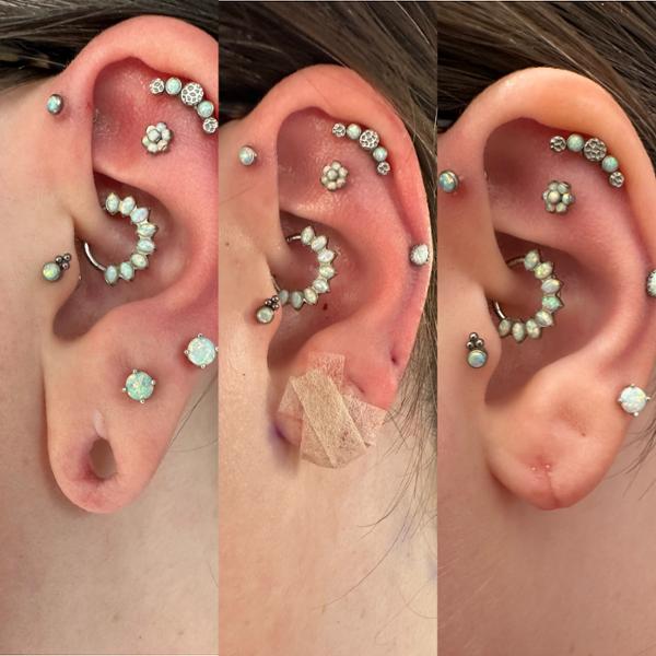 Stretched Ear Lobe Reconstruction