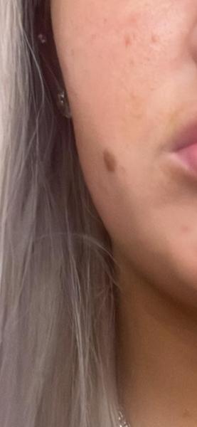 Laser mole removal