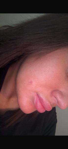 Laser mole removal
