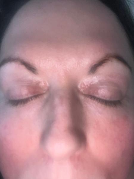 I had a excellent result with my xanthelasma removal on both eye lids