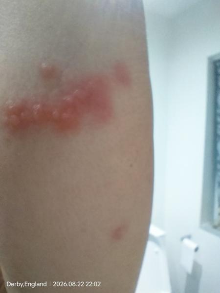 BEDBUGS 🤢🤯