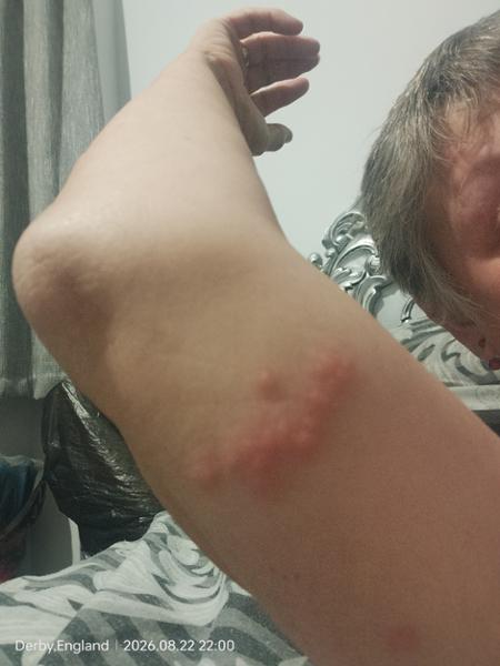 BEDBUGS 🤢🤯