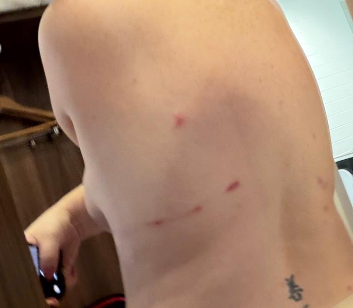 Pulled the skin off my back
